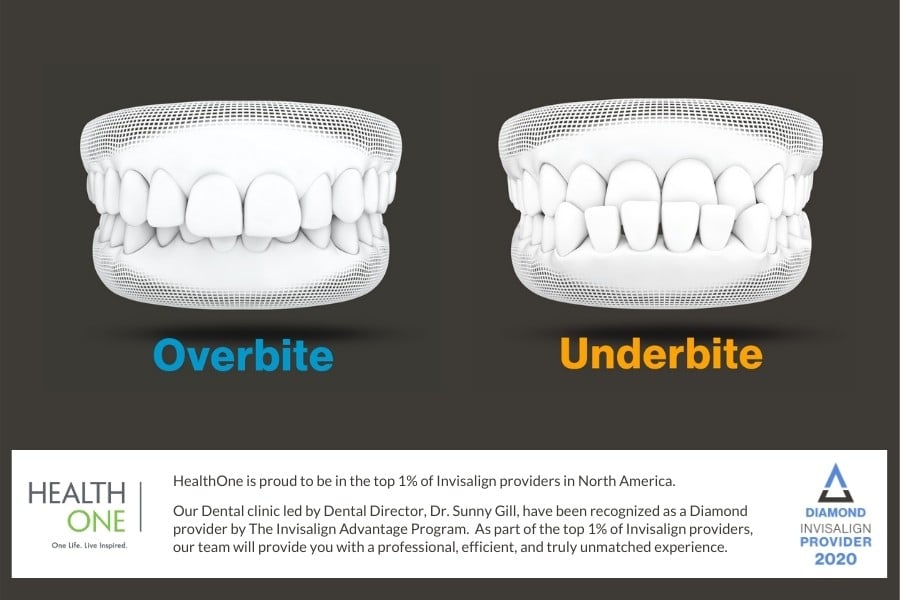 diagram of Overbite and underbite Teeth