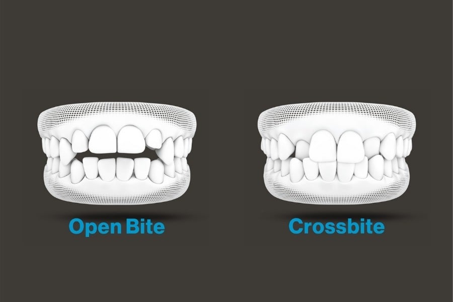 diagram of Open bite and cross bite