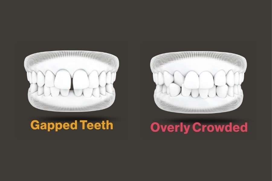 Diagram of Gapped Teeth and Overly Crowded 