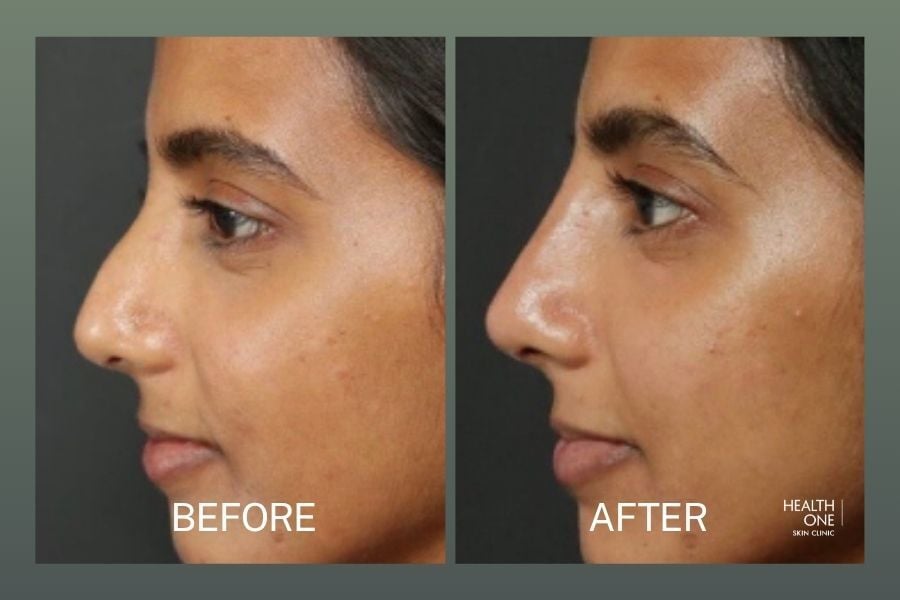 Before After Rhinoplasty injectable