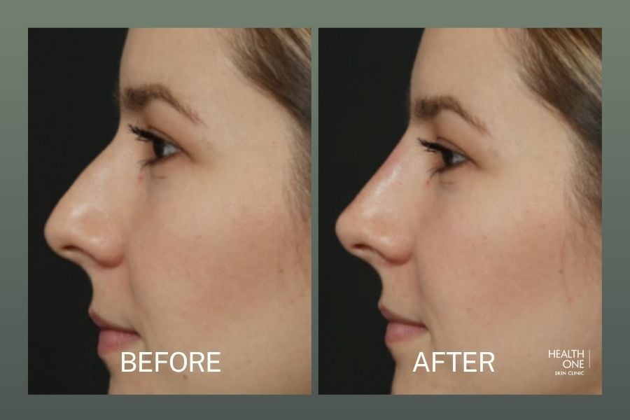 Before After Rhinoplasty