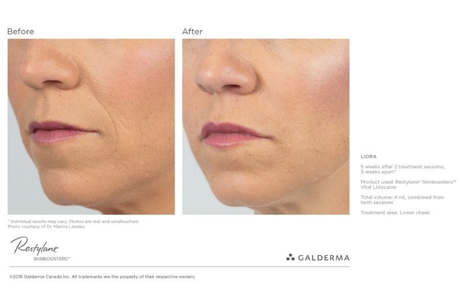 Before and After Dermal Fillers_2