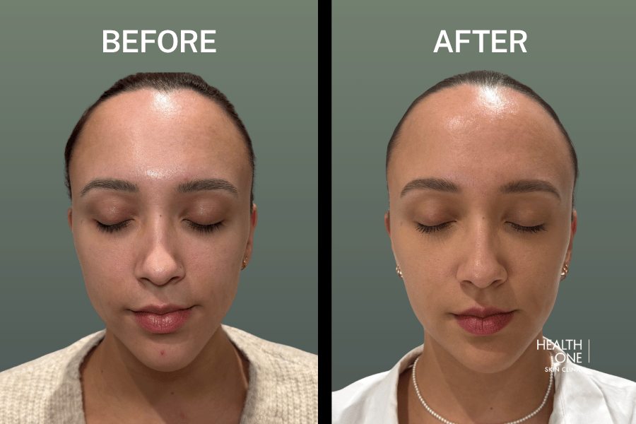 Face BeforeAfter