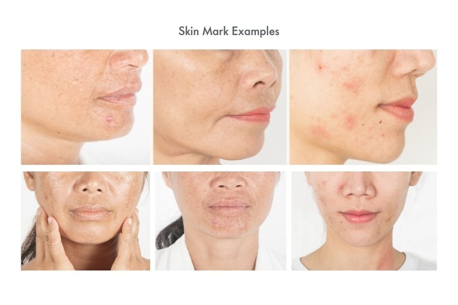 Skin Mark Examples