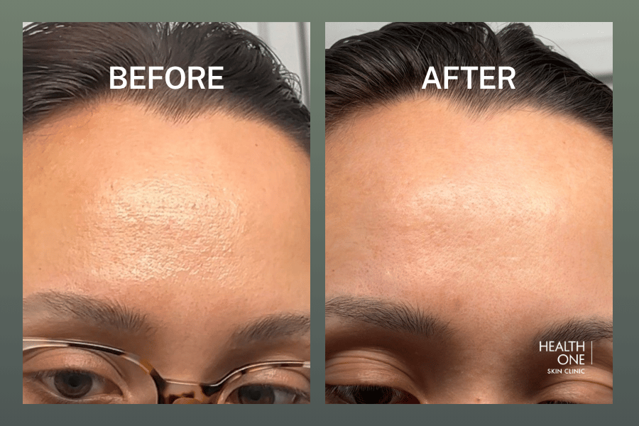 Forehead BeforeAfter