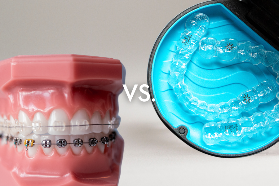 Invisalign vs Braces