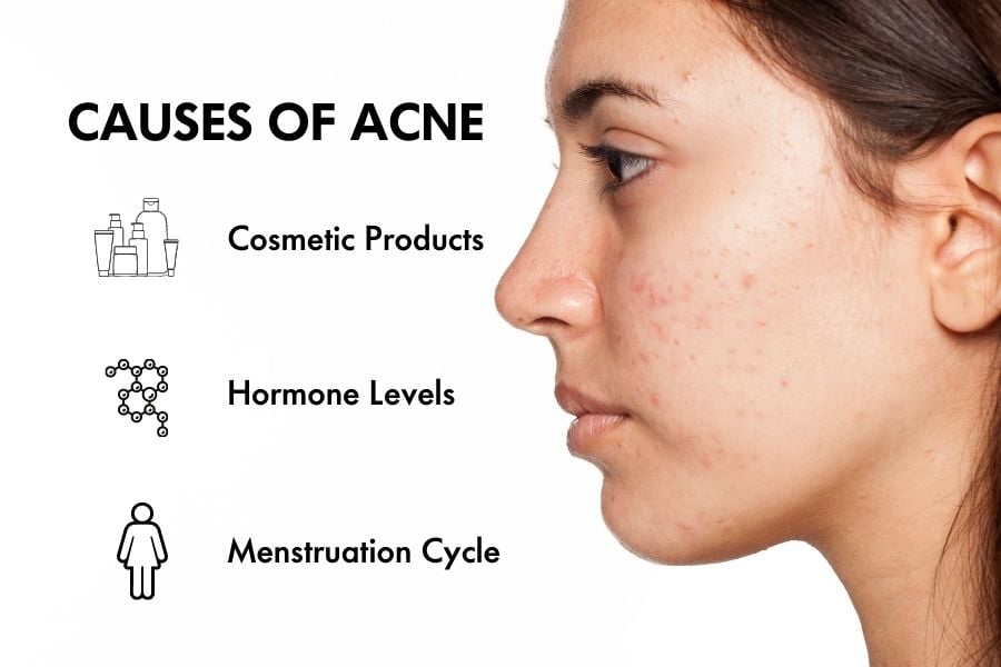 Causes Of Acne