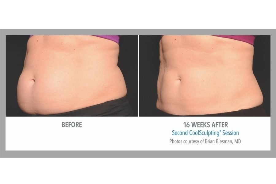 Results after CoolSculpting