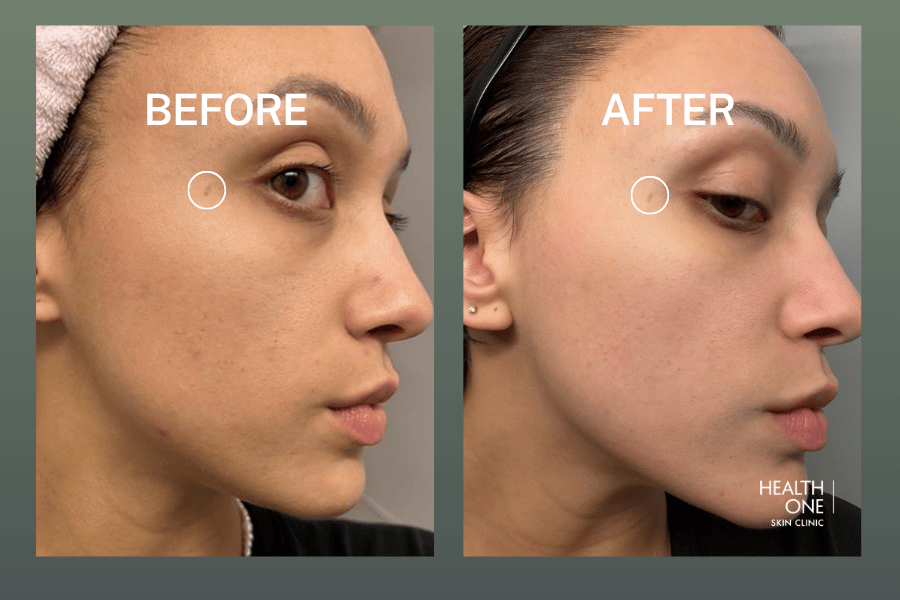 Mark BeforeAfter