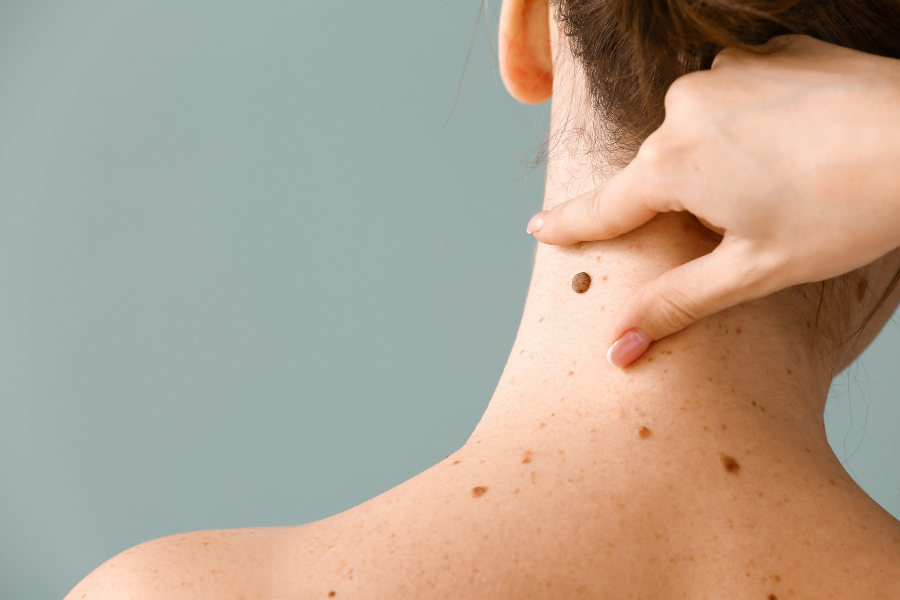 Skin Moles On Your Body