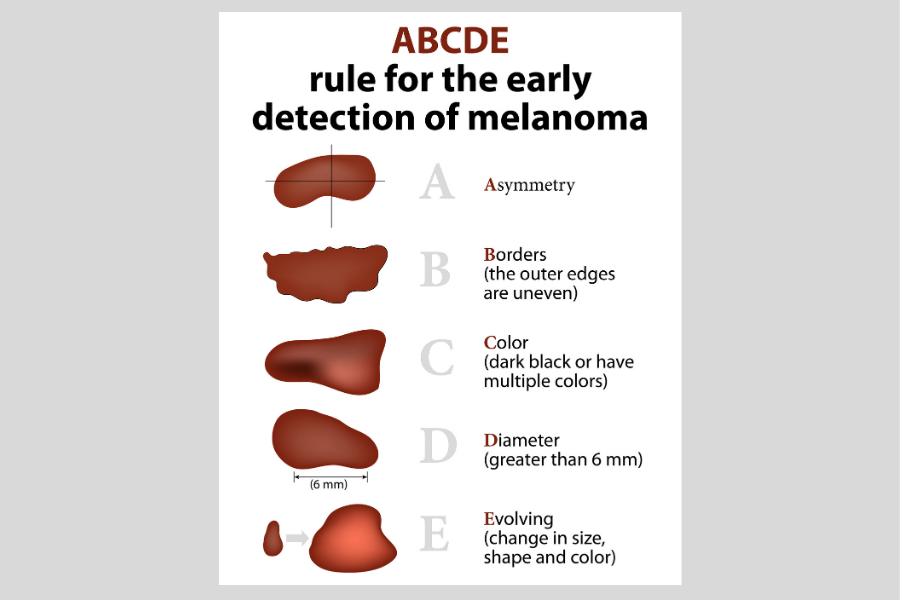 rules for the early detection of melanoma