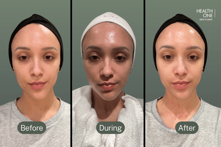 Microneedling Before After