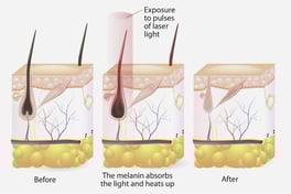 Sept-blog-laser-hair-removal-quesitons_2